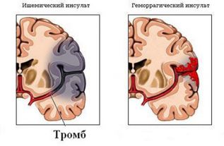 Ишемический или геморрагический?